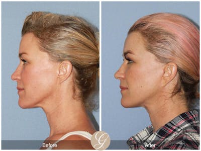 Facelift 40s Before & After Gallery - Patient 386285 - Image 1