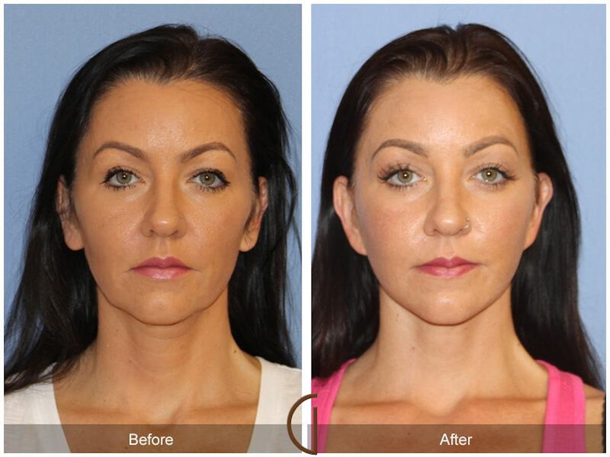 Facelift 40s Before & After Gallery - Patient 108461 - Image 2