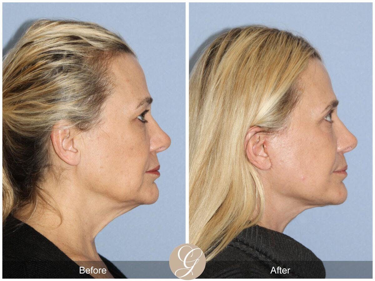Facelift 40s Before & After Gallery - Patient 114477 - Image 3