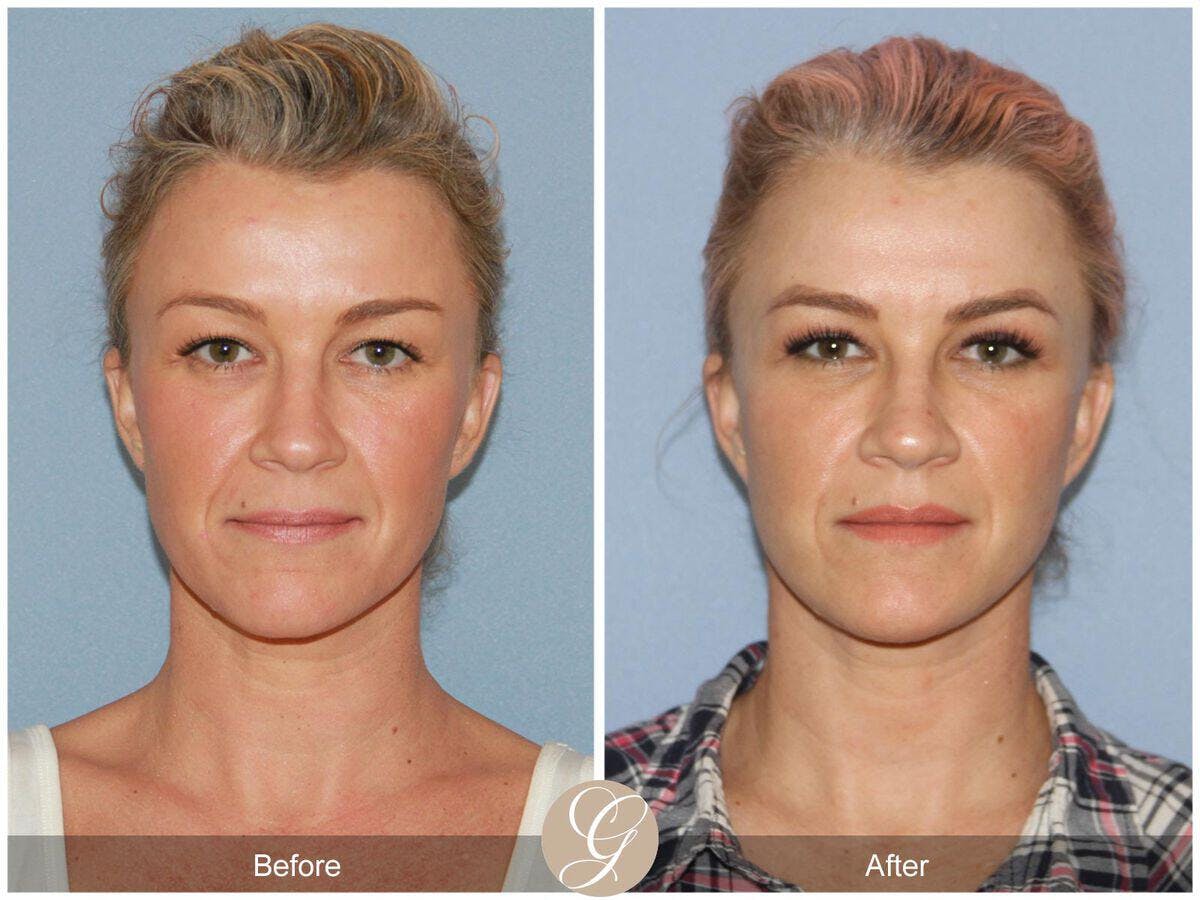 Facelift 40s Before & After Gallery - Patient 386285 - Image 2