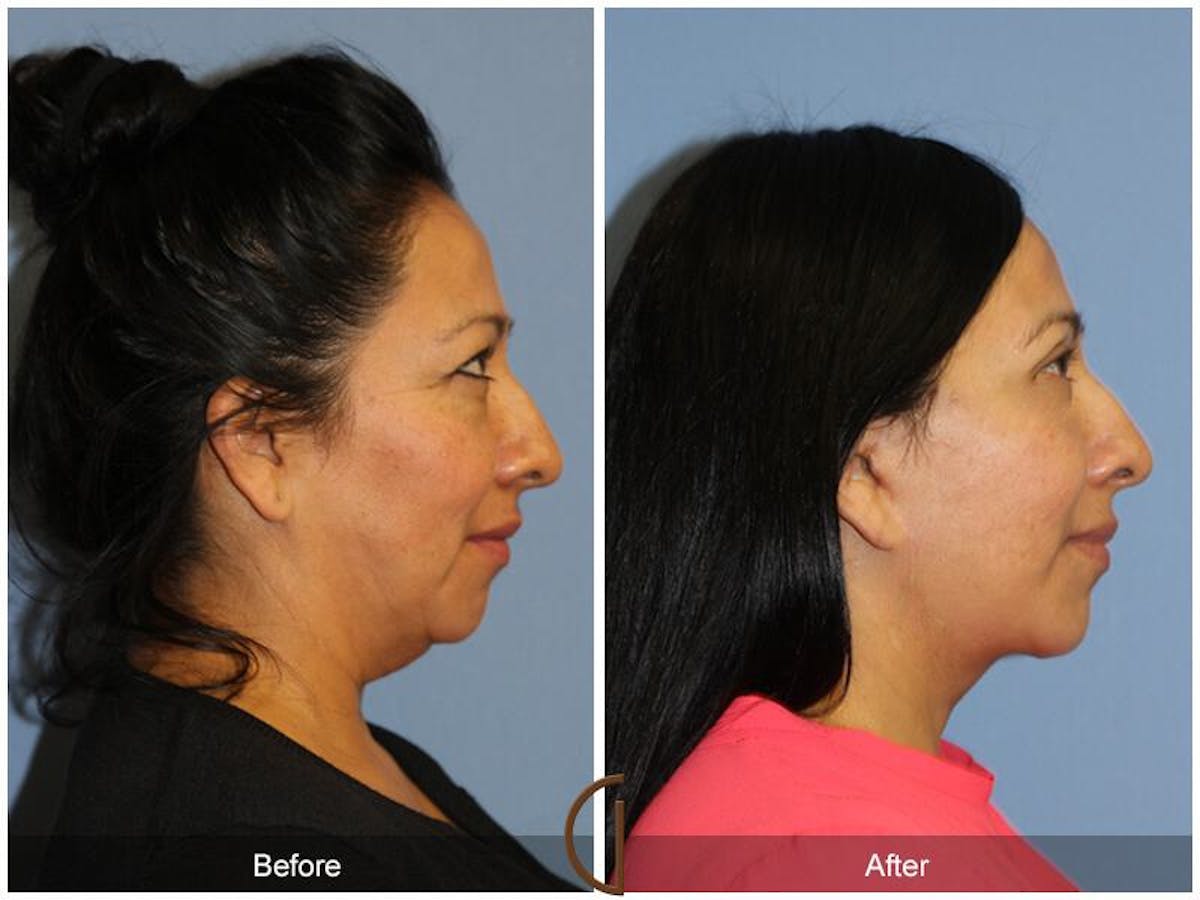 Facelift 40s Before & After Gallery - Patient 383907 - Image 3