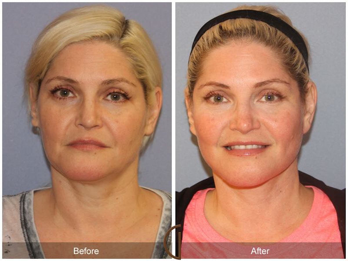 Facelift 40s Before & After Gallery - Patient 822940 - Image 2