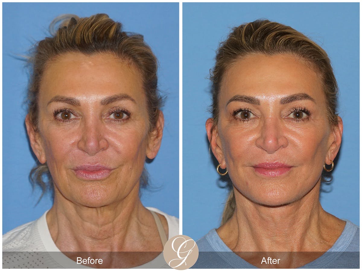 Deep Plane Facelift Before & After Gallery - Patient 210910 - Image 1
