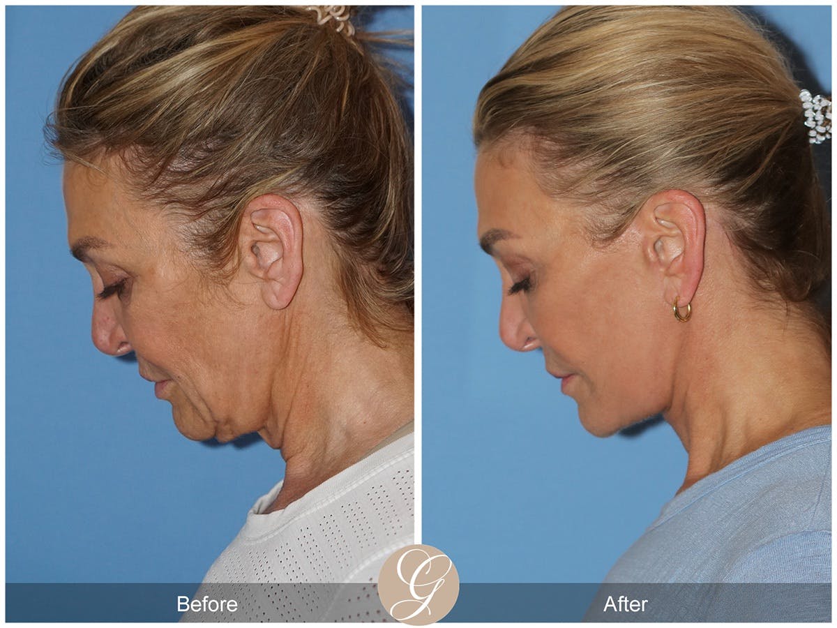 Deep Plane Facelift Before & After Gallery - Patient 210910 - Image 2