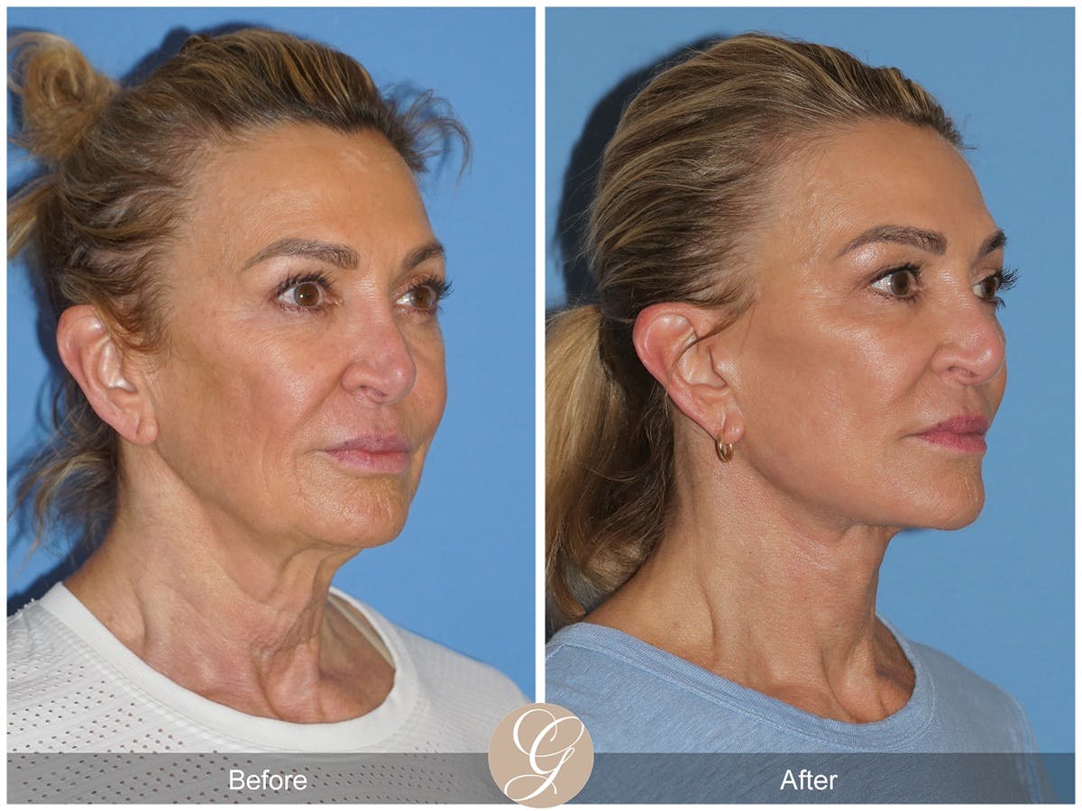 Deep Plane Facelift Before & After Gallery - Patient 210910 - Image 3
