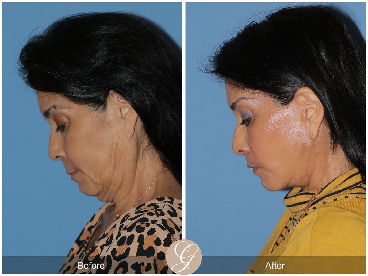 Deep Plane Facelift Before & After Gallery - Patient 266008 - Image 2