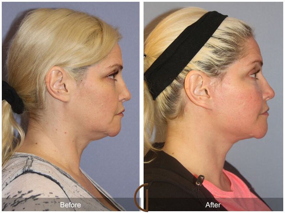 Facelift 40s Before & After Gallery - Patient 822940 - Image 3