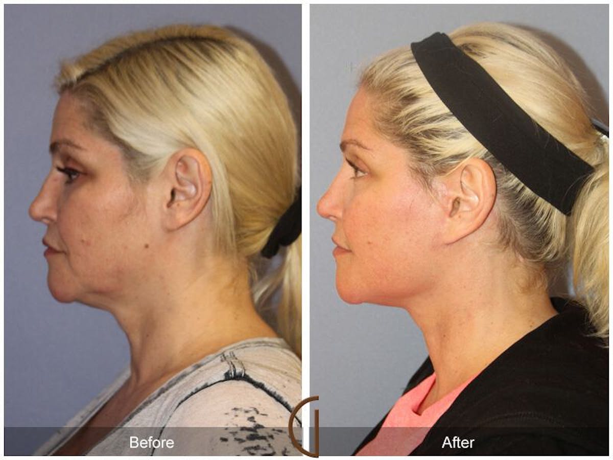 Facelift 40s Before & After Gallery - Patient 822940 - Image 1