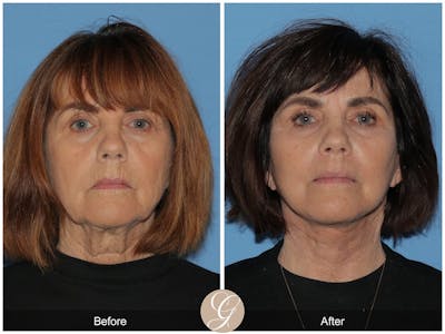 Deep Plane Facelift Before & After Gallery - Patient 577619 - Image 1