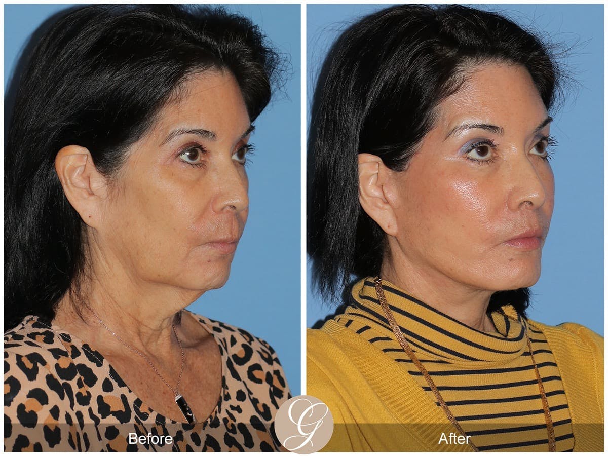 Deep Plane Facelift Before & After Gallery - Patient 266008 - Image 3
