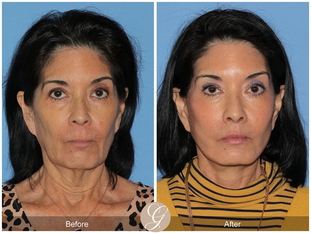 Deep Plane Facelift Before & After Gallery - Patient 266008 - Image 1
