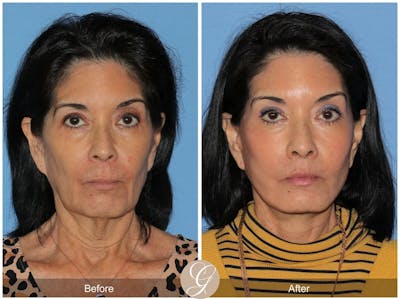 Deep Plane Facelift Before & After Gallery - Patient 266008 - Image 1