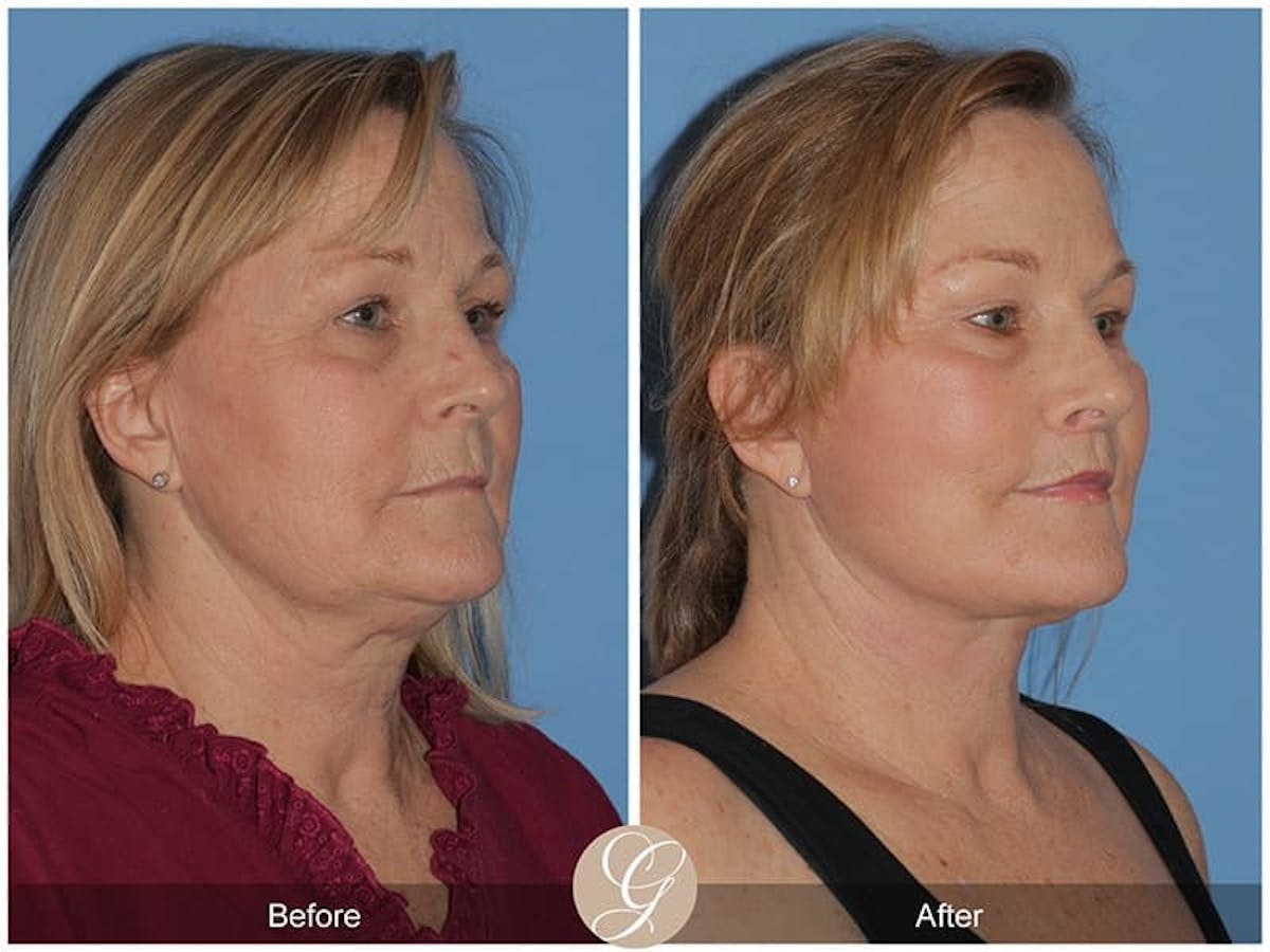 Deep Plane Facelift Before & After Gallery - Patient 177673 - Image 2