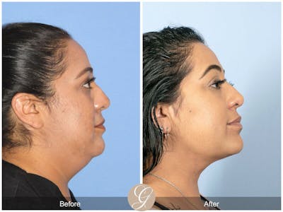 Neck Liposuction Before & After Gallery - Patient 690293 - Image 1