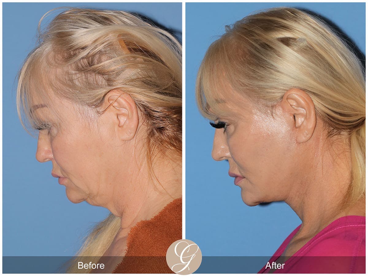 Deep Plane Facelift Before & After Gallery - Patient 181640 - Image 2