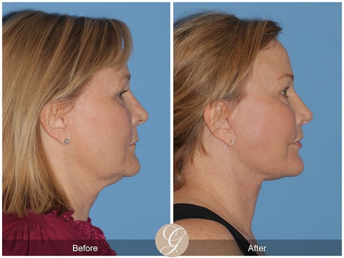 Deep Plane Facelift Before & After Gallery - Patient 177673 - Image 3