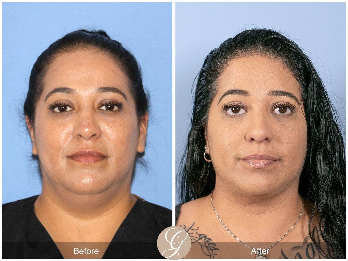 Neck Liposuction Before & After Gallery - Patient 690293 - Image 2