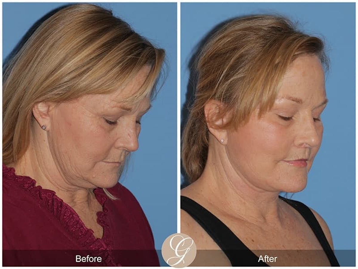 Deep Plane Facelift Before & After Gallery - Patient 177673 - Image 1