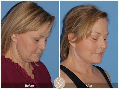 Deep Plane Facelift Before & After Gallery - Patient 177673 - Image 1