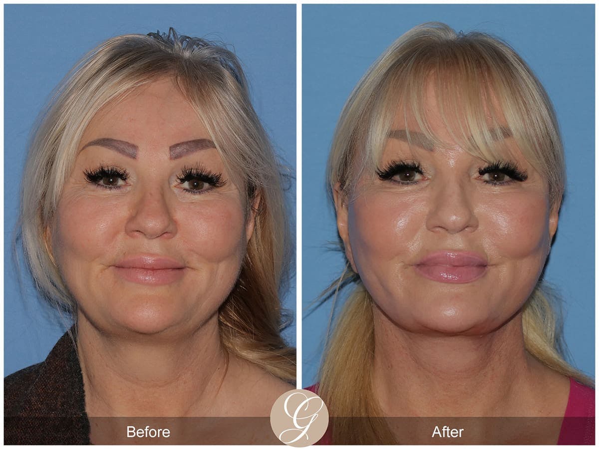 Deep Plane Facelift Before & After Gallery - Patient 181640 - Image 1