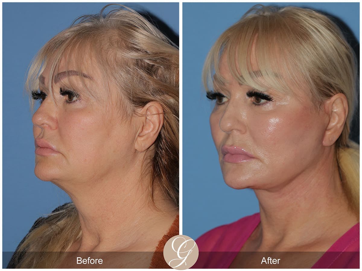 Deep Plane Facelift Before & After Gallery - Patient 181640 - Image 3