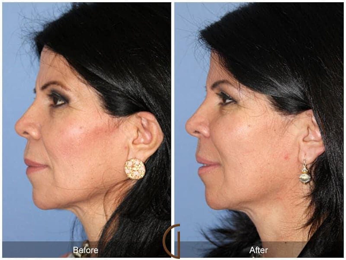 Facial Fat Grafting Before & After Gallery - Patient 293175 - Image 1