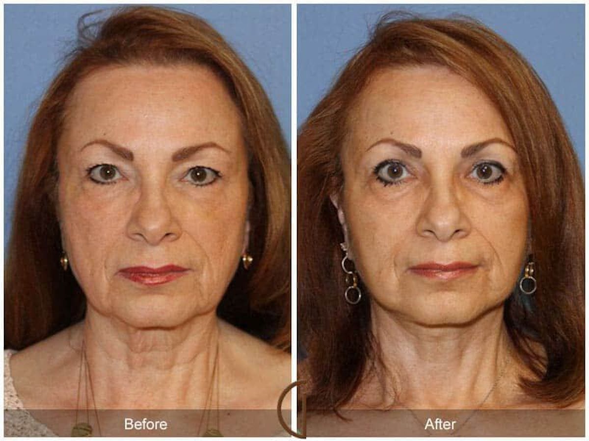 Facial Fat Grafting Before & After Gallery - Patient 297722 - Image 2