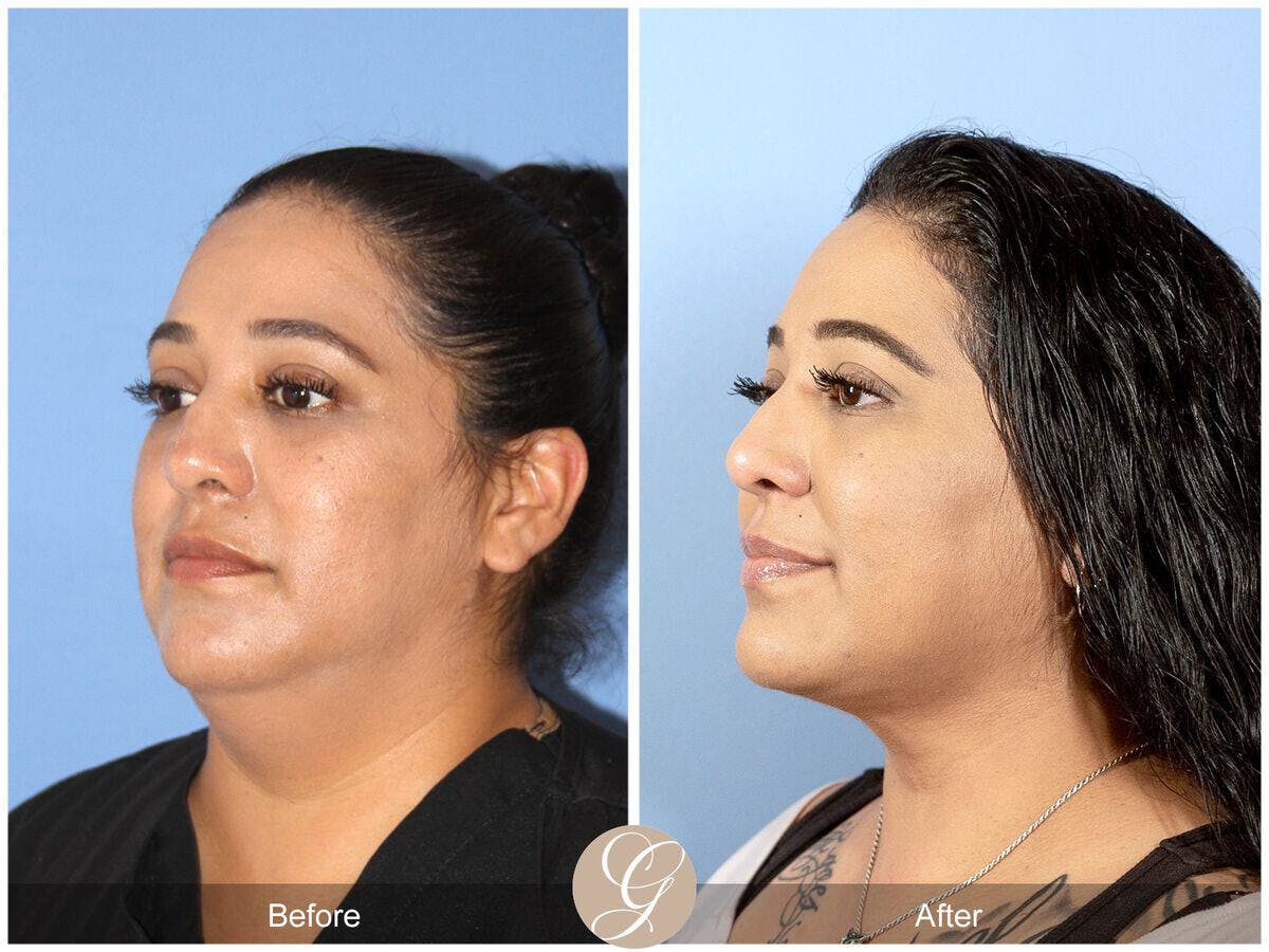 Neck Liposuction Before & After Gallery - Patient 690293 - Image 4