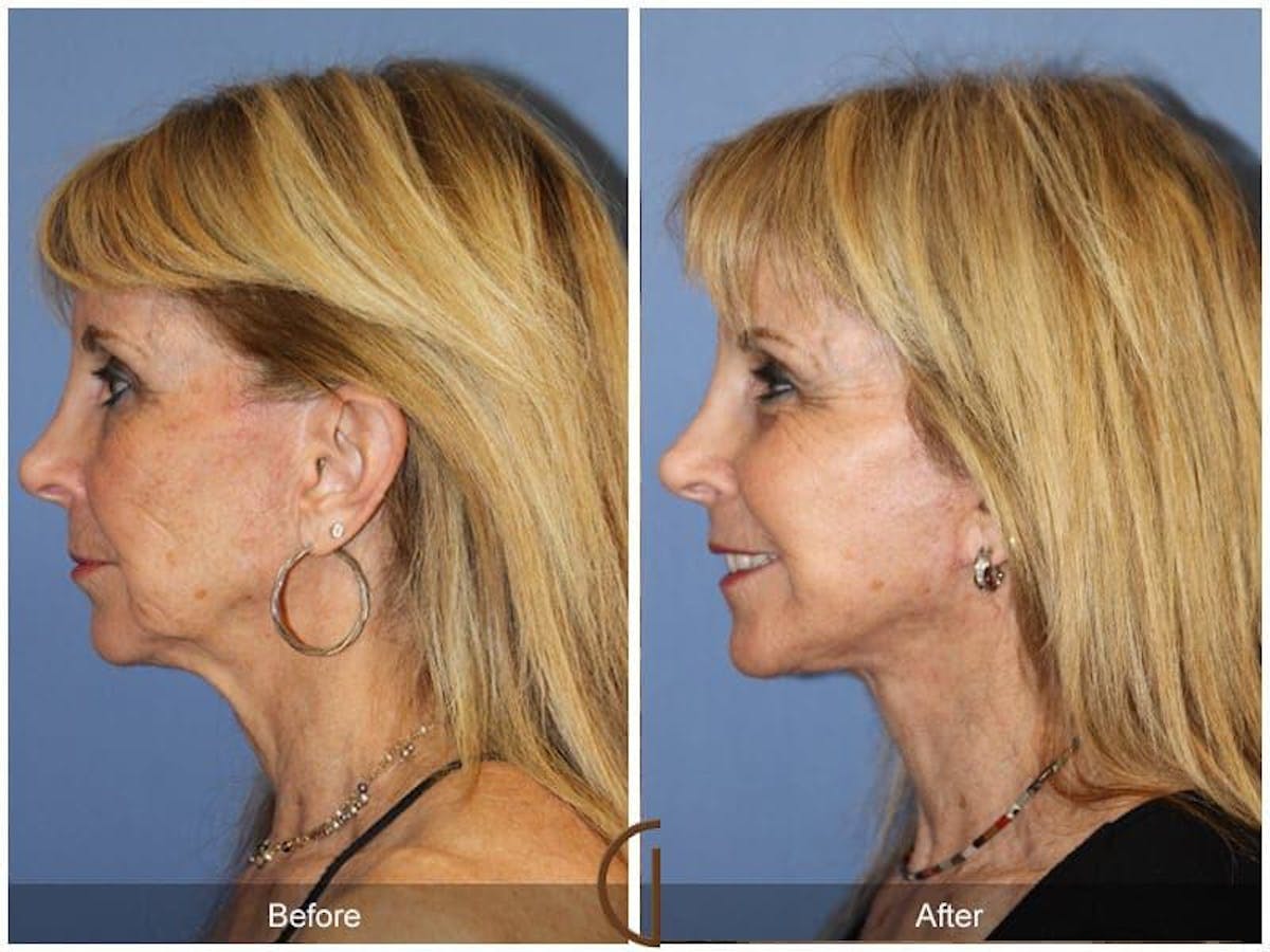 Facial Fat Grafting Before & After Gallery - Patient 219711 - Image 1