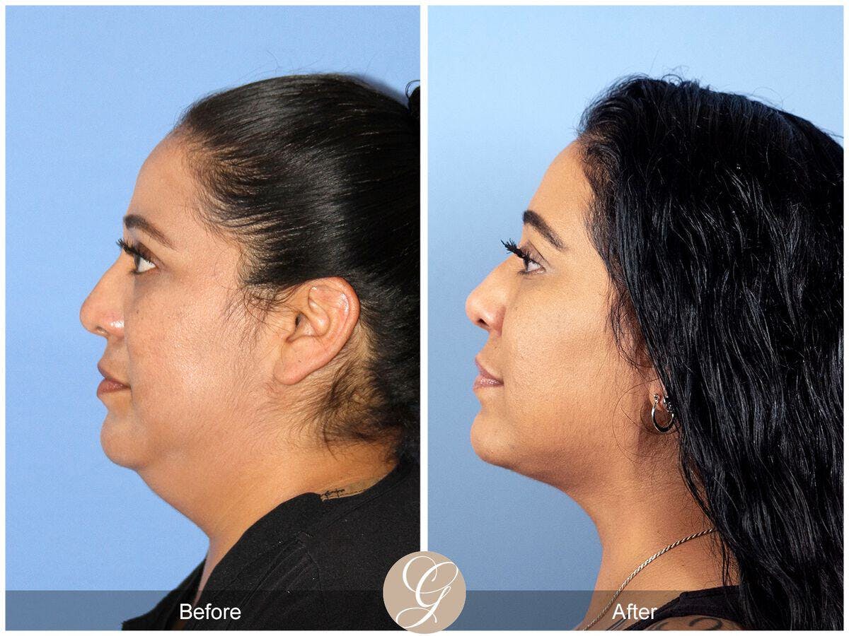 Neck Liposuction Before & After Gallery - Patient 690293 - Image 3