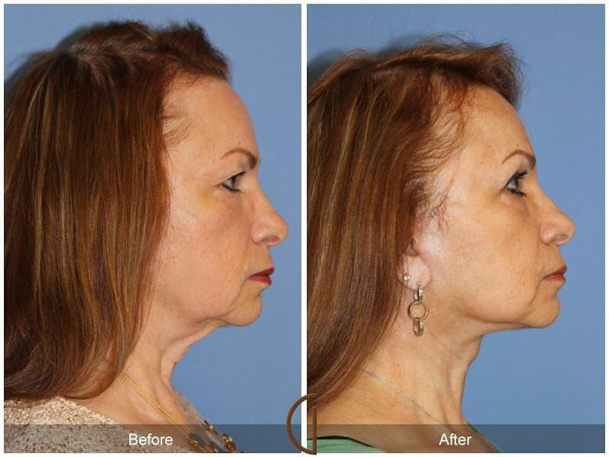Facial Fat Grafting Before & After Gallery - Patient 297722 - Image 3