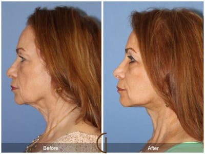 Facial Fat Grafting Before & After Gallery - Patient 297722 - Image 1