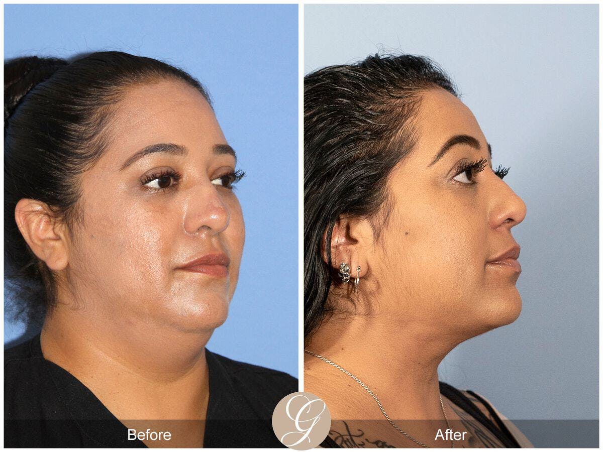 Neck Liposuction Before & After Gallery - Patient 690293 - Image 5
