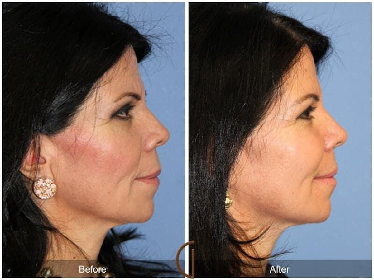 Facial Fat Grafting Before & After Gallery - Patient 293175 - Image 3