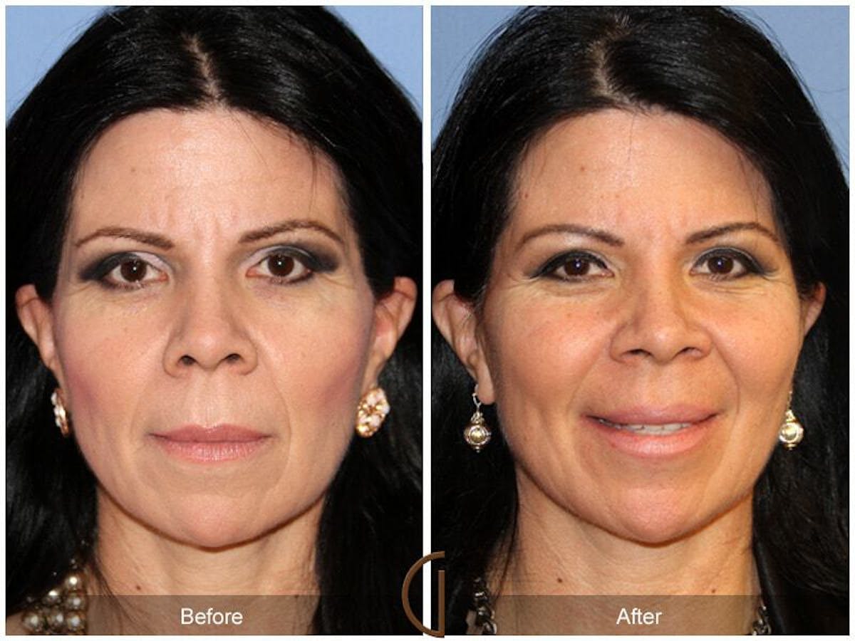 Facial Fat Grafting Before & After Gallery - Patient 293175 - Image 2