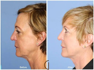 Facial Fat Grafting Before & After Gallery - Patient 831819 - Image 1