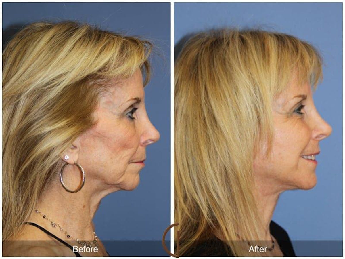 Facial Fat Grafting Before & After Gallery - Patient 219711 - Image 3