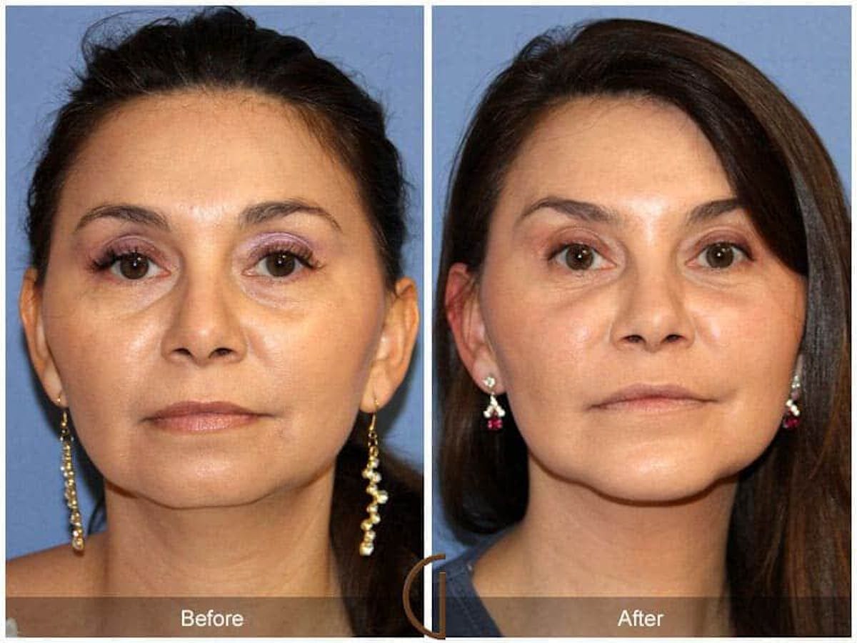 Facial Fat Grafting Before & After Gallery - Patient 286183 - Image 2