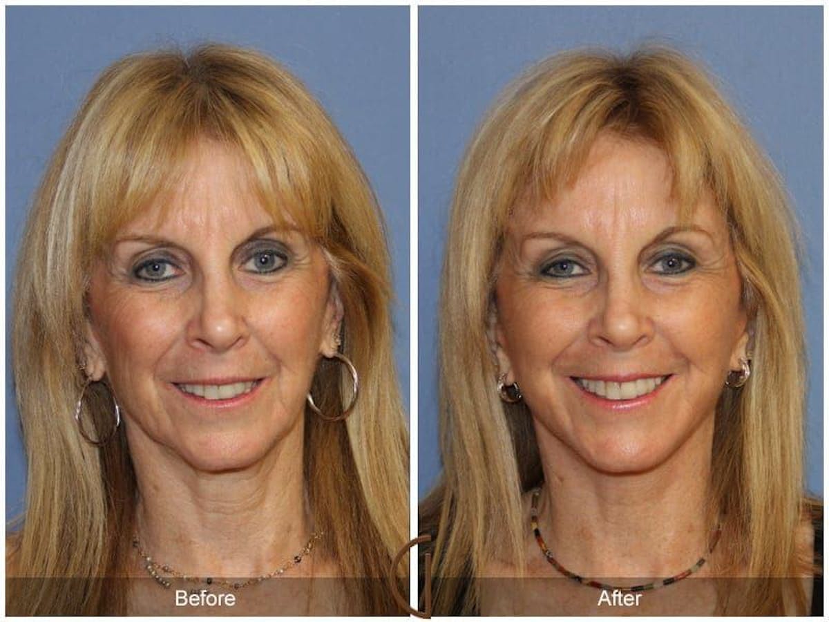 Facial Fat Grafting Before & After Gallery - Patient 219711 - Image 2