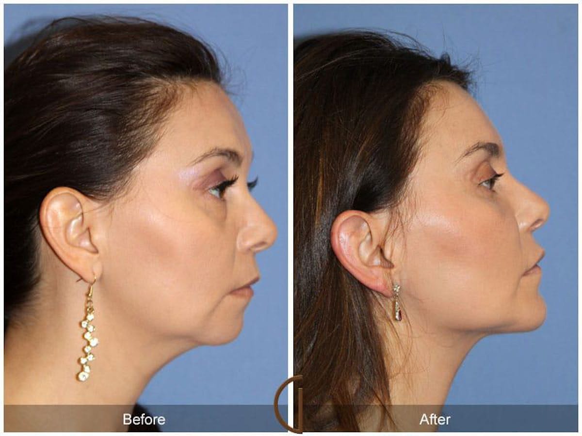 Facial Fat Grafting Before & After Gallery - Patient 286183 - Image 3