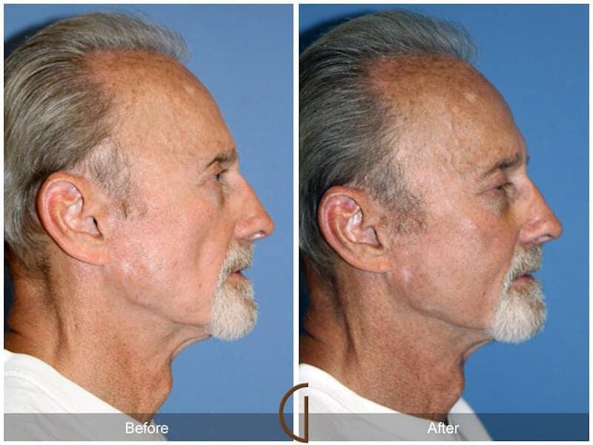 Facial Fat Grafting Before & After Gallery - Patient 325133 - Image 3