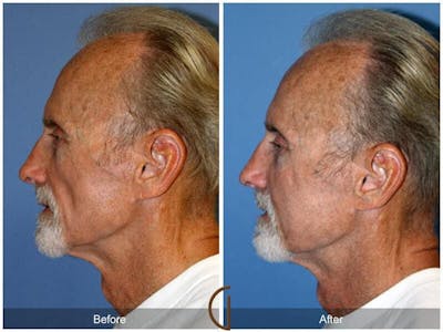 Facial Fat Grafting Before & After Gallery - Patient 325133 - Image 1