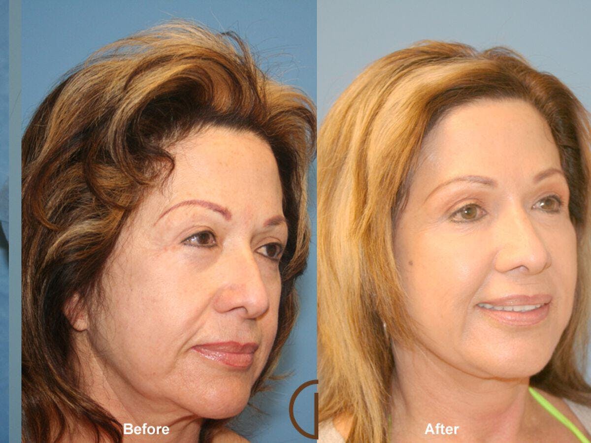 Facial Fat Grafting Before & After Gallery - Patient 302442 - Image 1