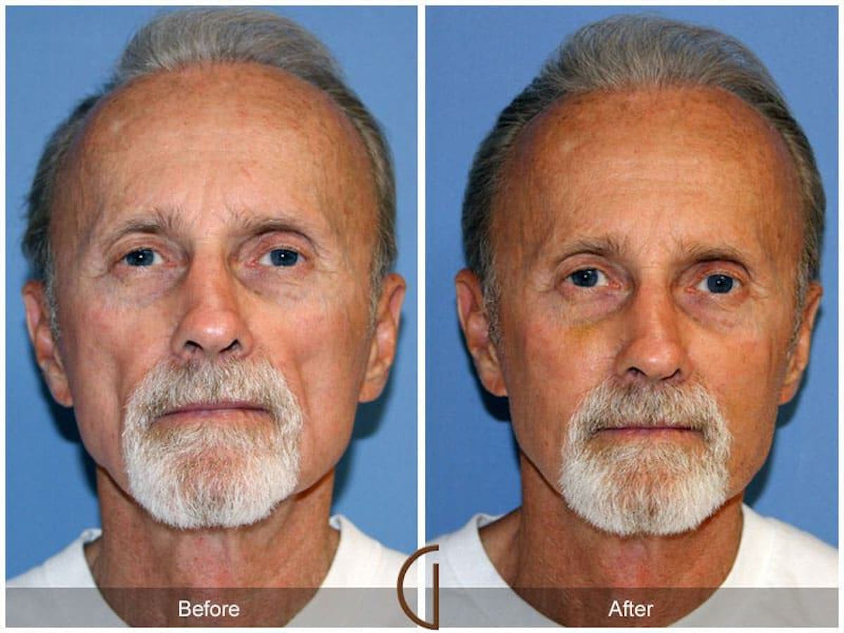 Facial Fat Grafting Before & After Gallery - Patient 325133 - Image 2