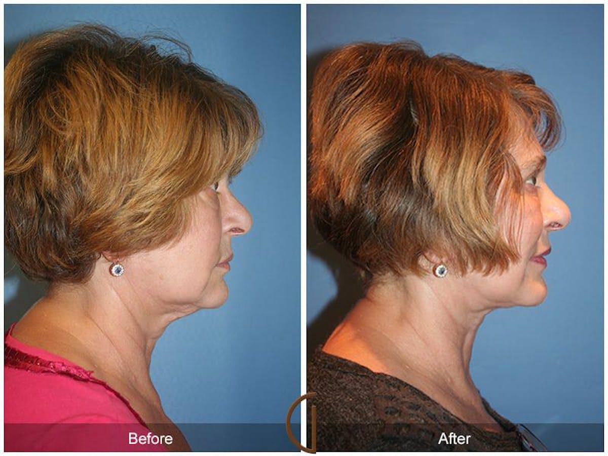 Facial Fat Grafting Before & After Gallery - Patient 269171 - Image 3