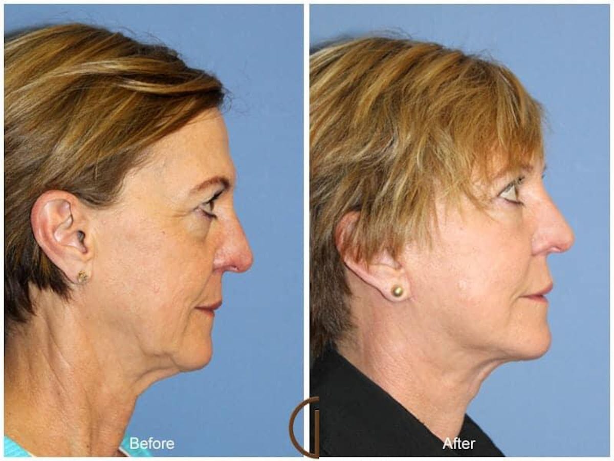 Facial Fat Grafting Before & After Gallery - Patient 831819 - Image 3
