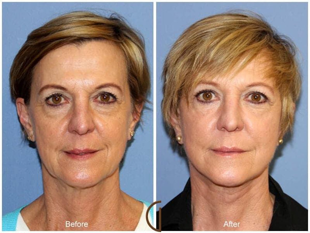 Facial Fat Grafting Before & After Gallery - Patient 831819 - Image 2