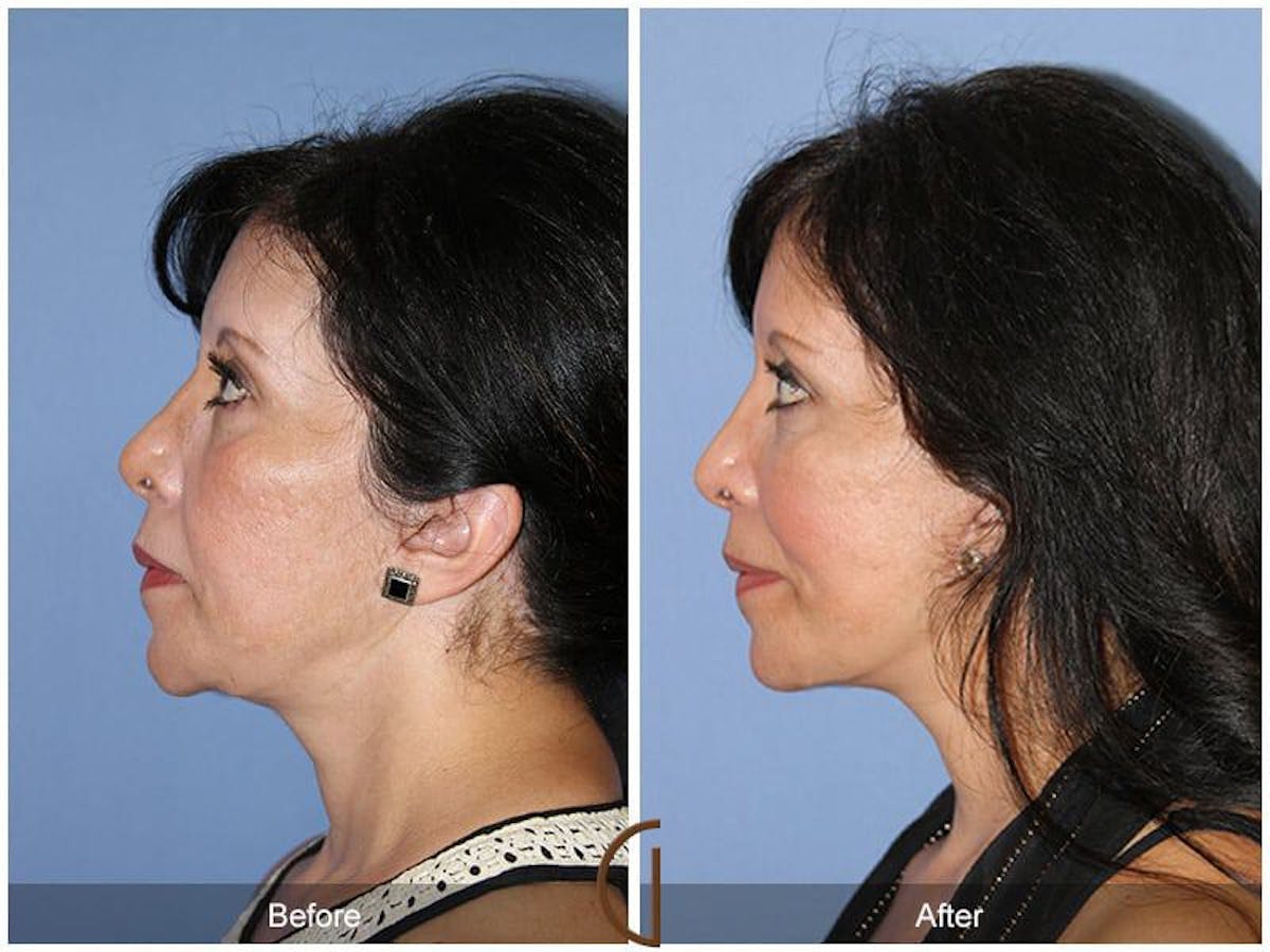 Facial Fat Grafting Before & After Gallery - Patient 180198 - Image 1