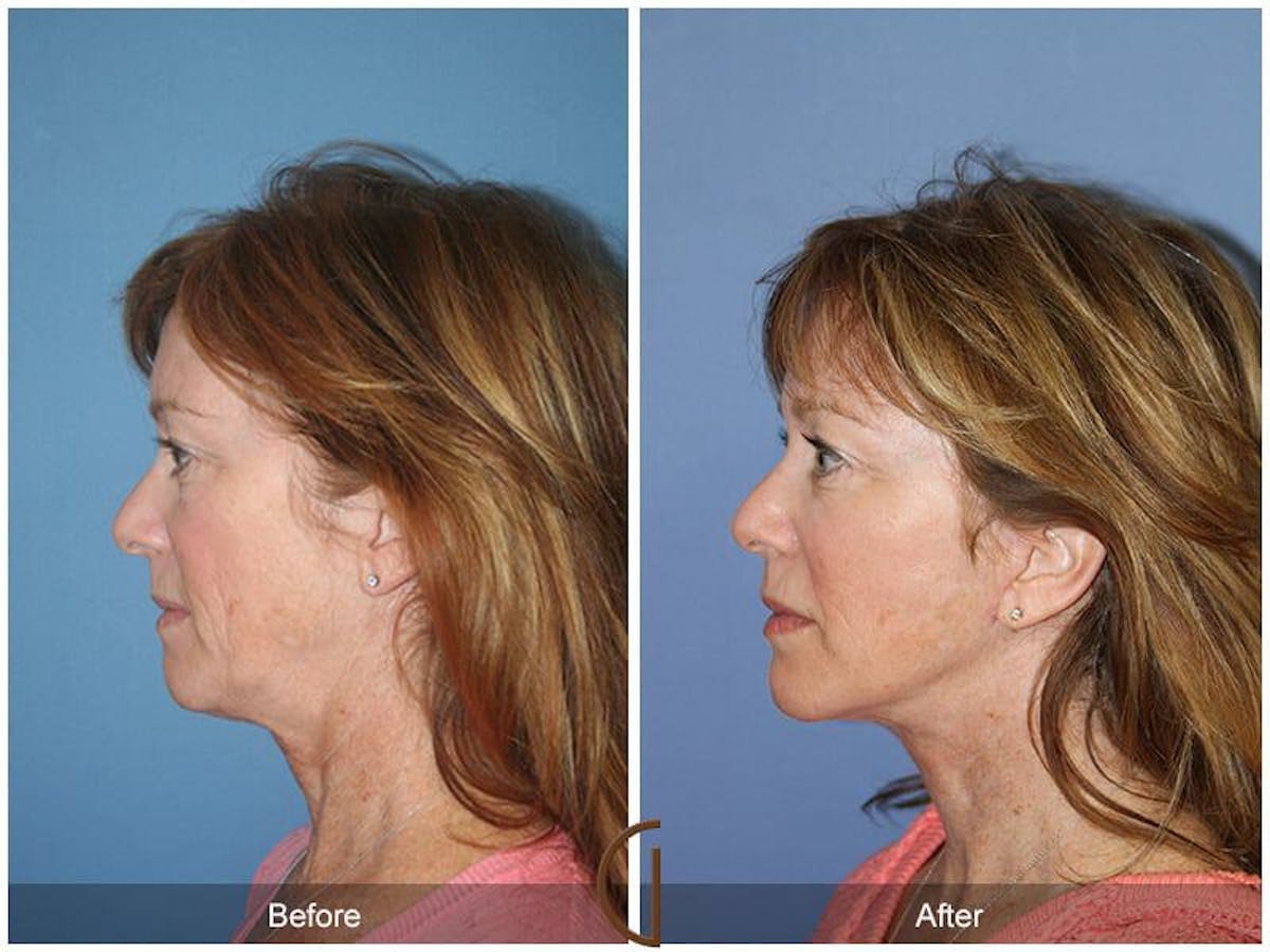 Facial Fat Grafting Before & After Gallery - Patient 400542 - Image 1
