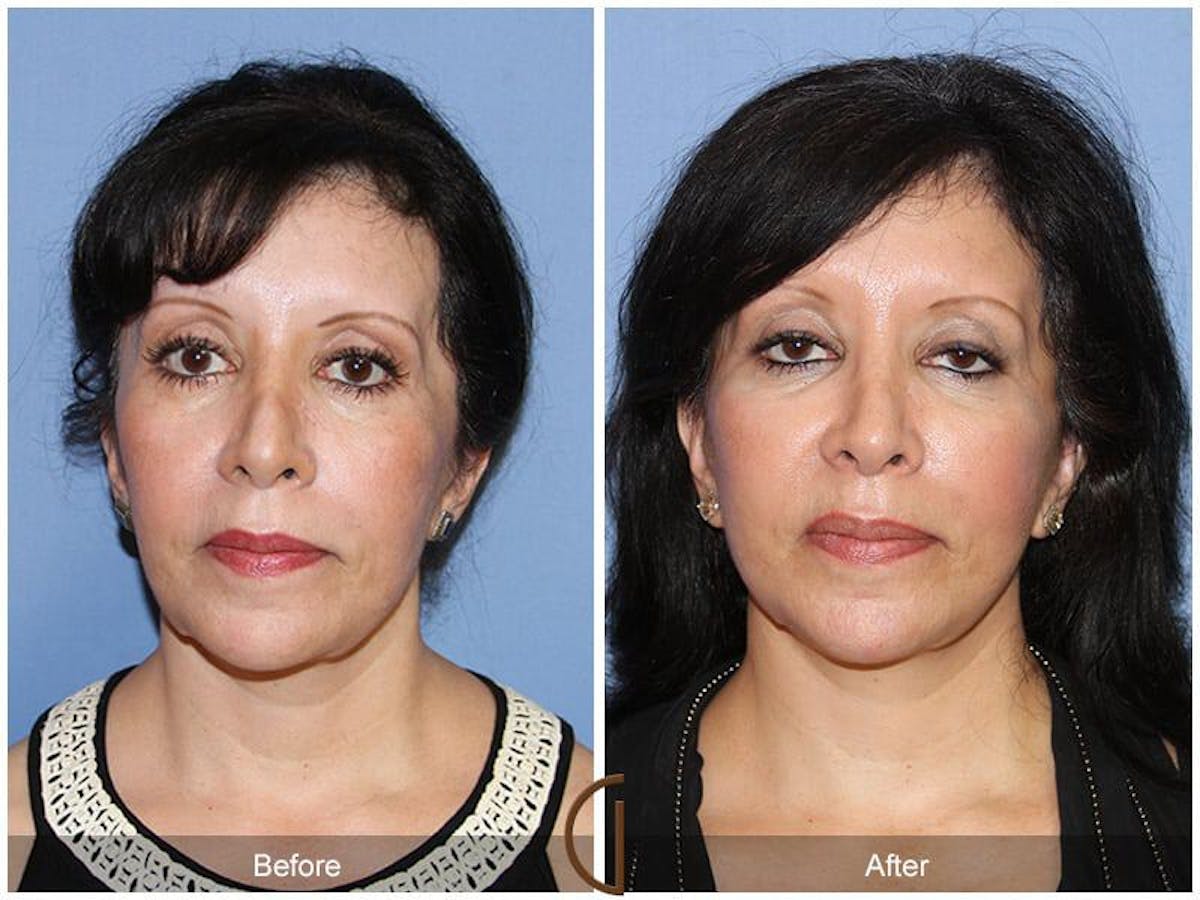 Facial Fat Grafting Before & After Gallery - Patient 180198 - Image 2